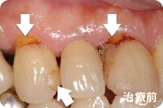 caries_case_01_before