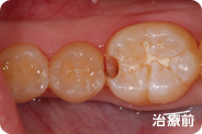 caries_case_01_before