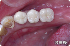 caries_case_01_after