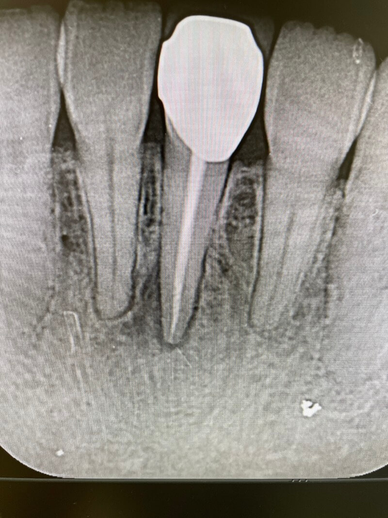 歯根嚢胞 自由が丘の歯医者・歯科｜自由が丘デンタルケア｜痛みのない質の高い治療